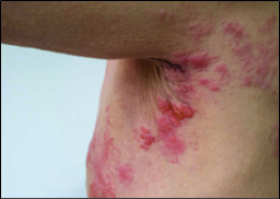 Shingles: The Gift that Keeps on Giving additional image