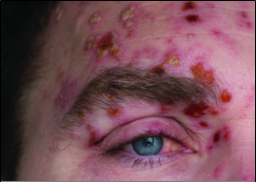 Shingles: The Gift that Keeps on Giving